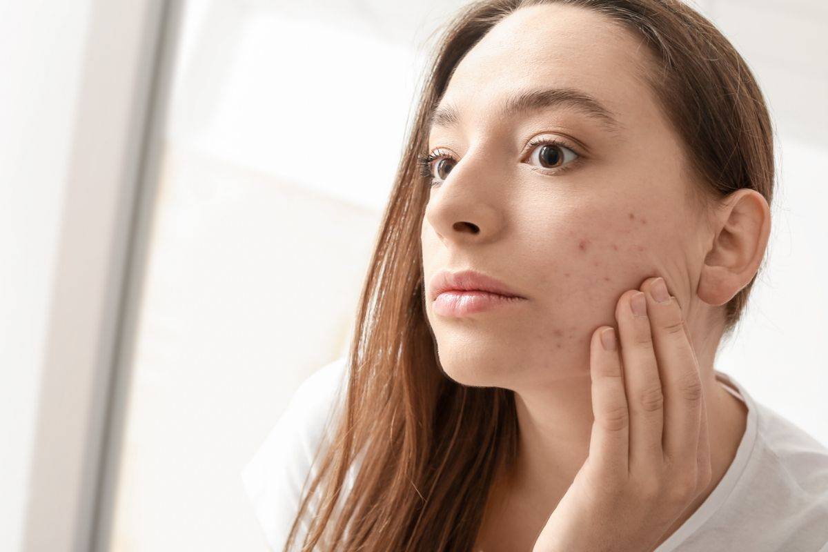 Best Treatment for Hormonal Acne