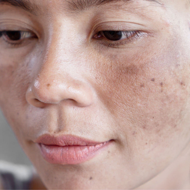 Woman with hyperpigmentation on her face