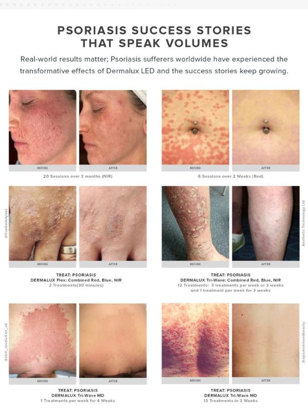 Dermalux Flex MD