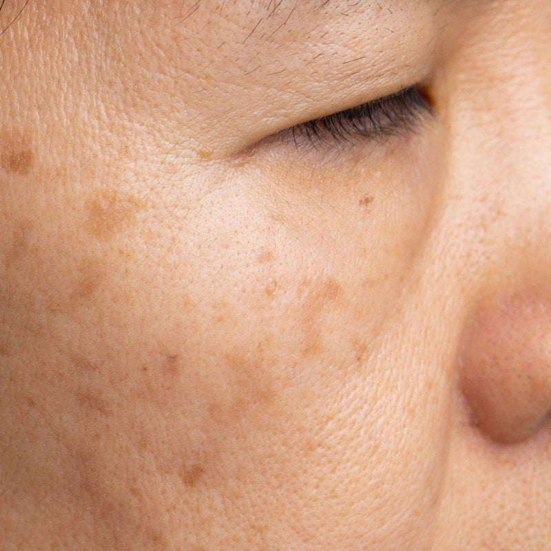 Top #5 Tips to Fight Pigmentation