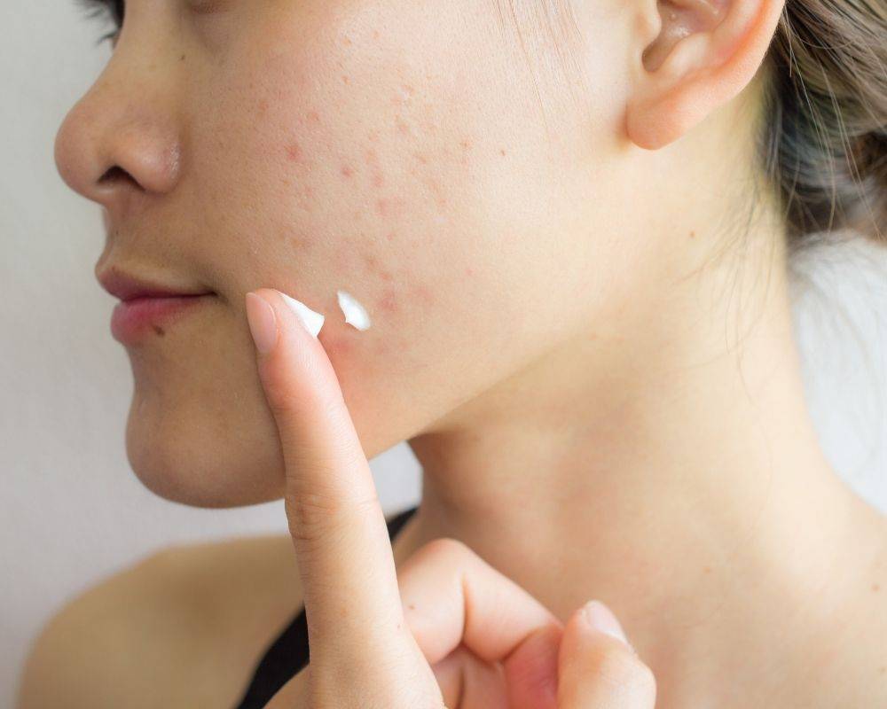 10 Fundamental Rules to Fight Acne