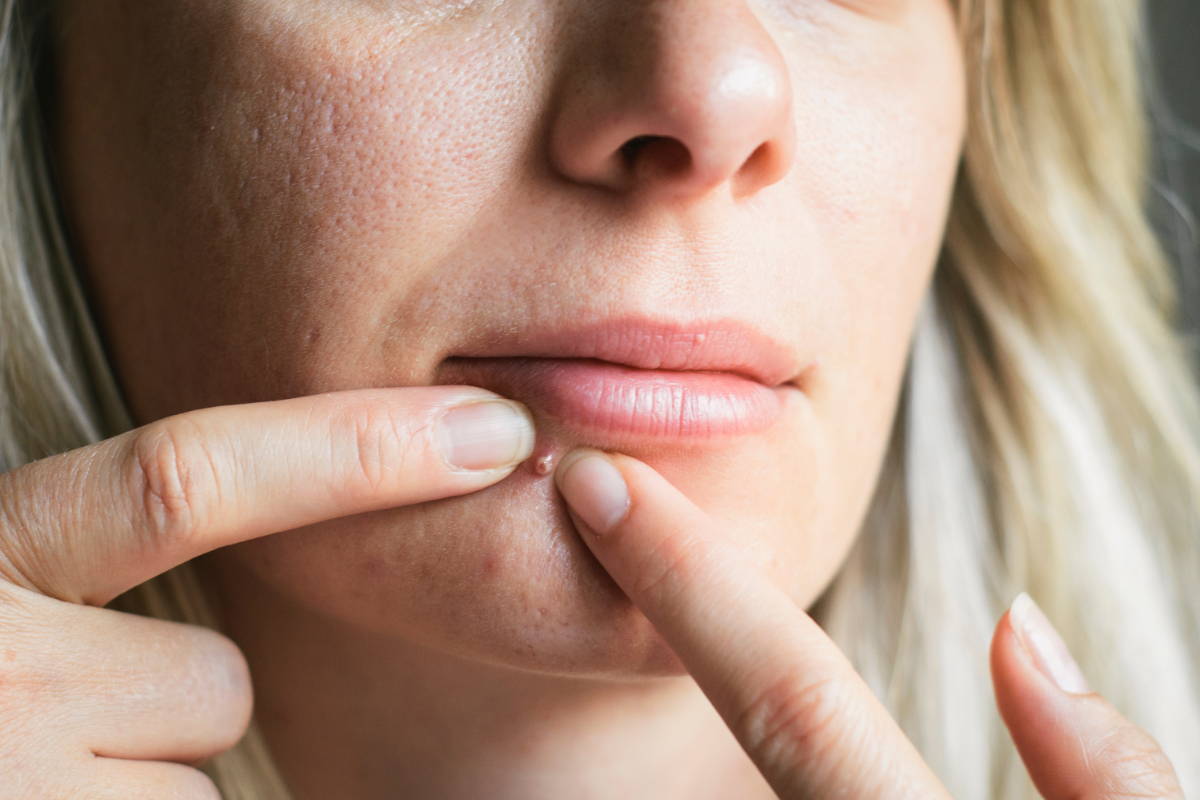 Should I Squeeze Pimples?