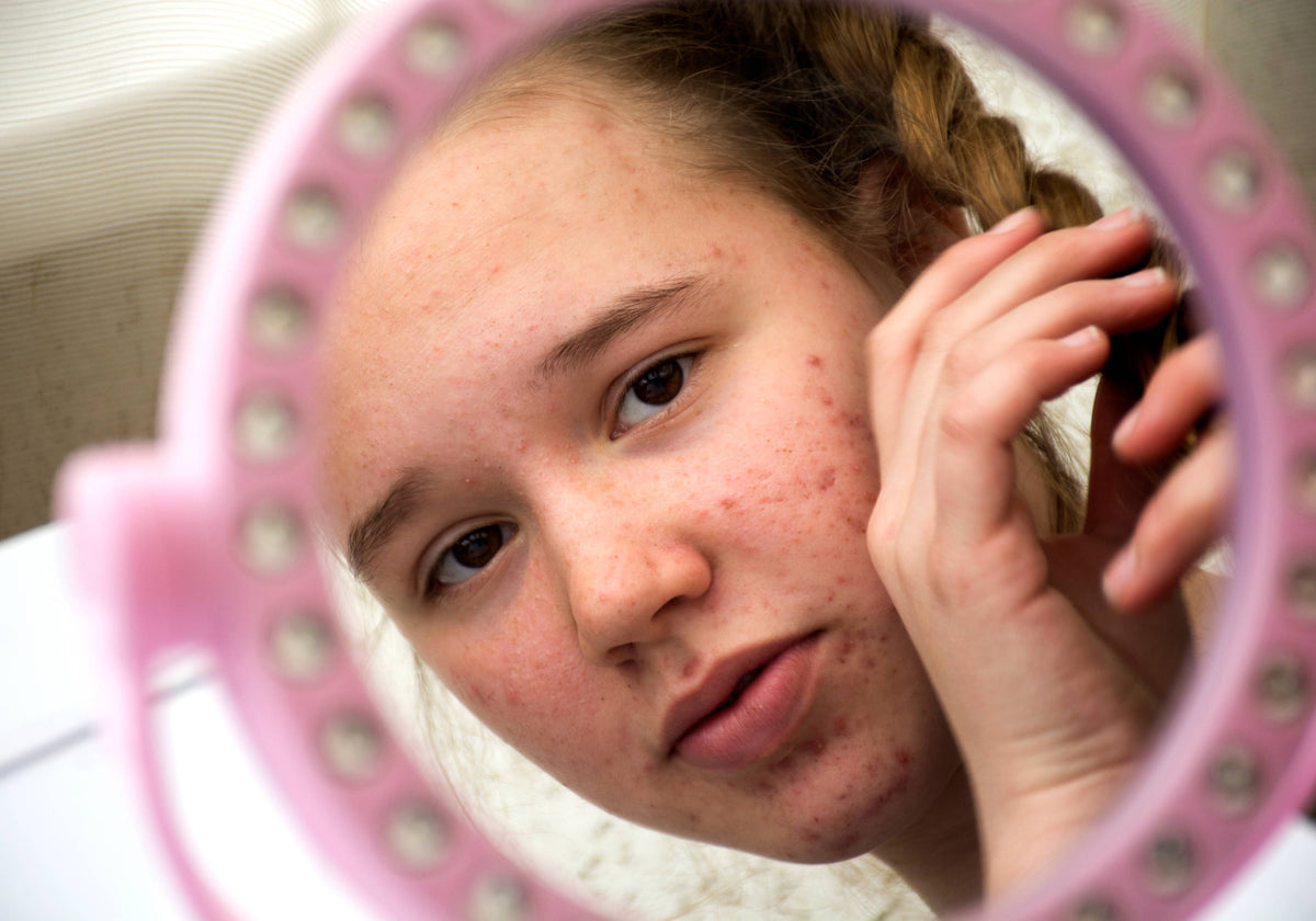Tackling Teenage Skin