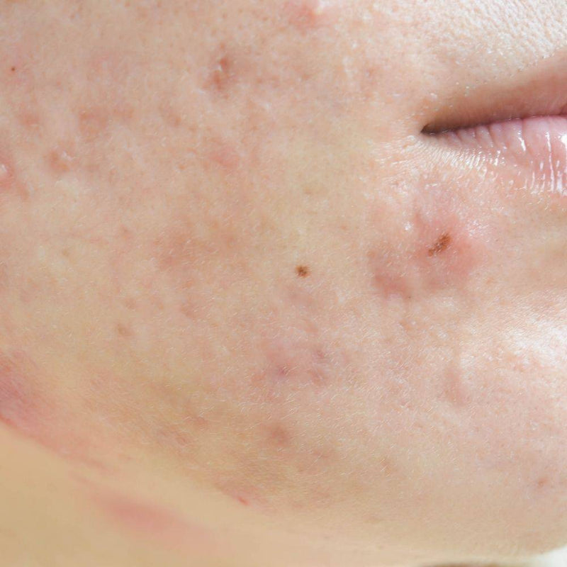Your Guide to Treat Post Inflammatory Hyperpigmentation