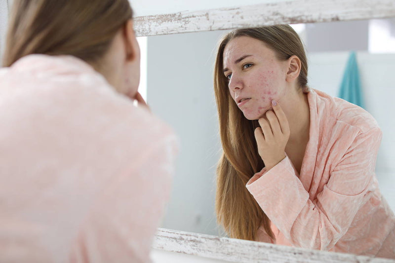 Acne, Not Just a Teenage Challenge?