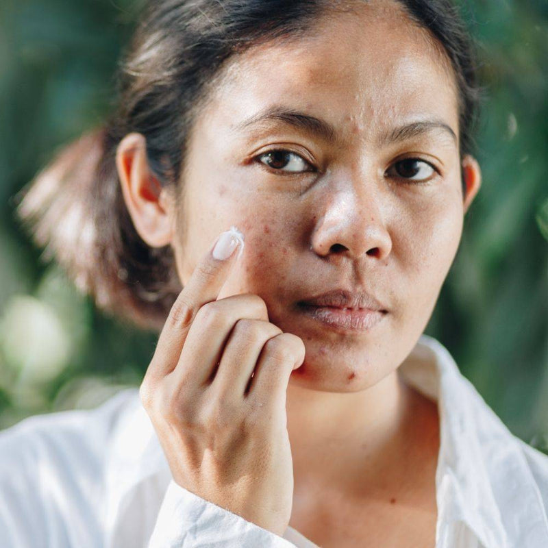 Why Do I Still Have Acne?