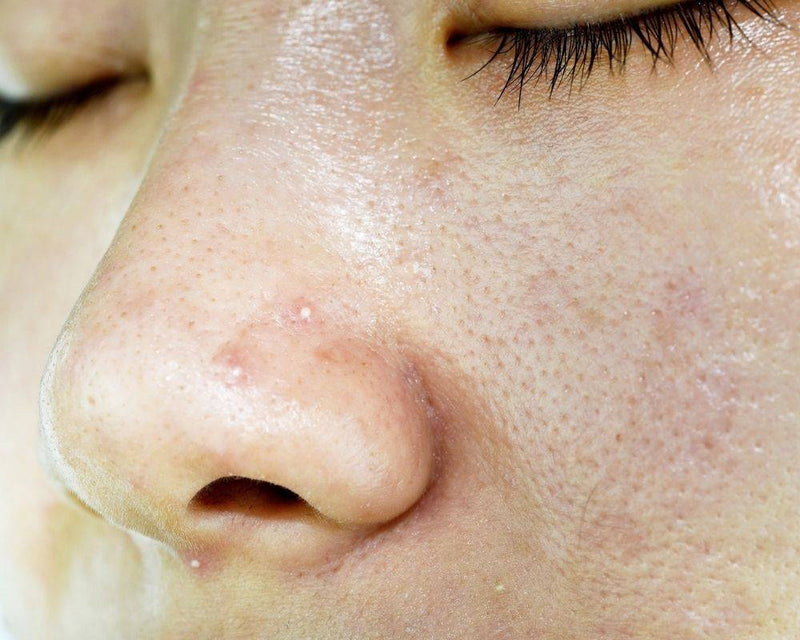 Is Dermalogica Good For Oily Skin?