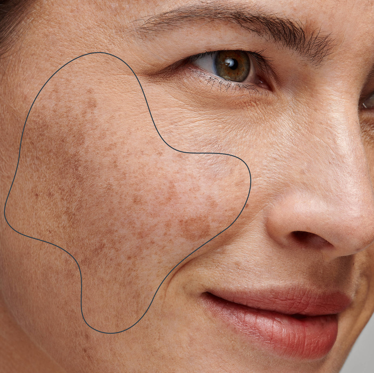 How Do You Treat Skin Pigmentation?