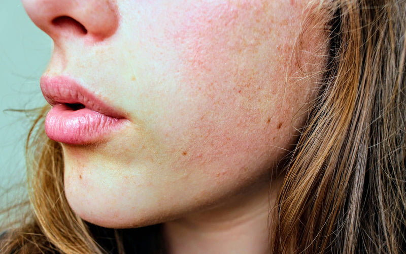 10 things you can do for a Sensitive/Rosacea Skin
